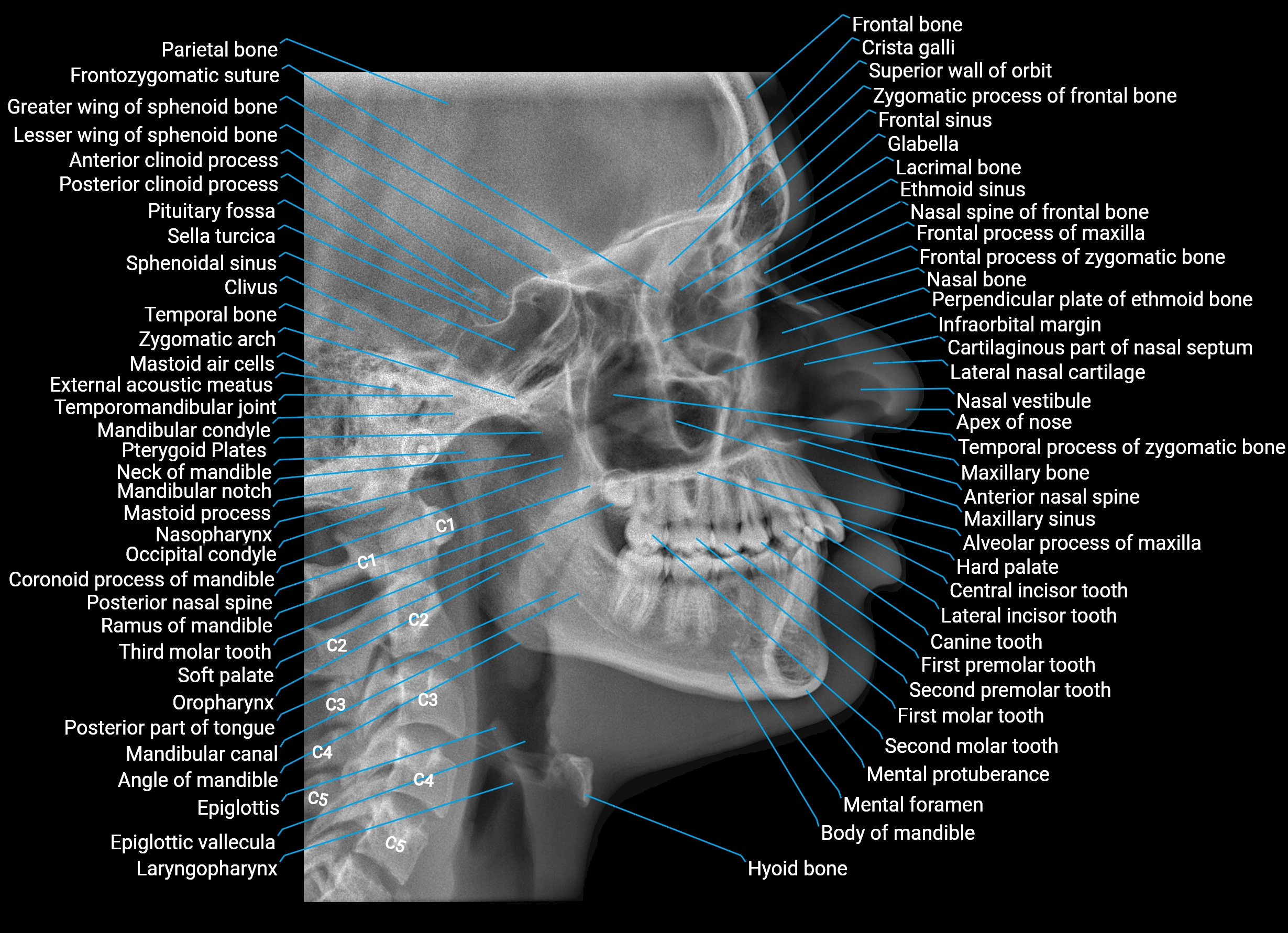 cephalogram x ray anatomy labelled image 1.webp